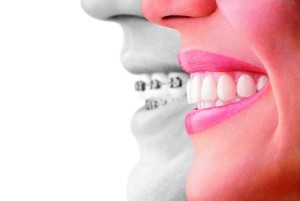 invisalign compare to braces